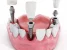 Impressions Dental Care | Dental Clinic in Dadar | Best Dentist in Dadar | Dental Implants in Dadar Photo 1